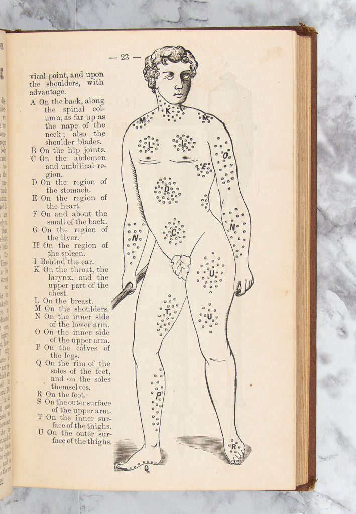 (QUACKERY). BAUNSCHEIDT, Carl. Le Baunscheidtisme.